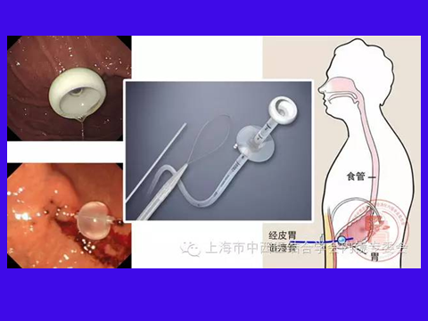【技术济世】告别胃管，吞咽困难患者的新选择！