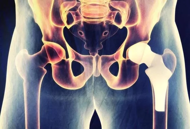 为什么有的人年纪轻轻，却患上股骨头坏死？