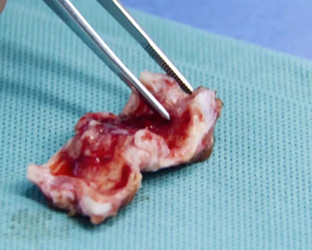 反复辗转求医,金沙洲医院胸外科妙手治愈顽疾!