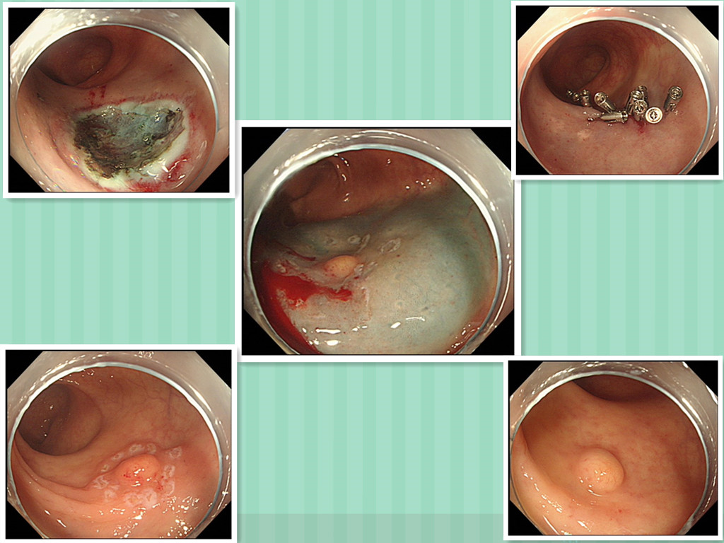 我院成功施行内镜粘膜下剥离术(ESD),再创学术新高!