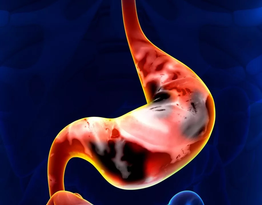 我院成功施行内镜粘膜下剥离术(ESD),再创学术新高!