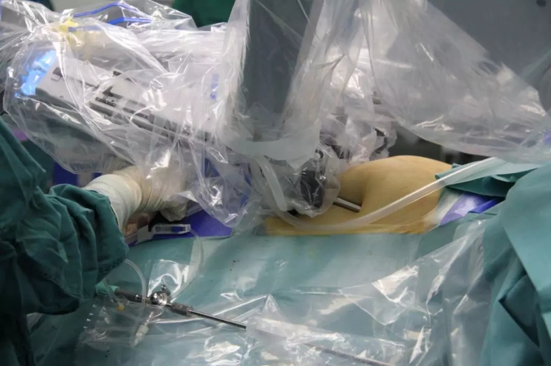 金沙洲医院成功开展首台达芬奇机器人手术,跨入“机器人时代”!