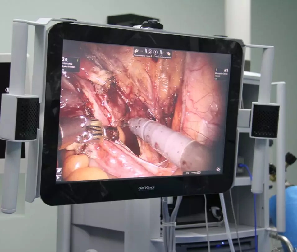 金沙洲医院成功开展首台达芬奇机器人手术,跨入“机器人时代”!